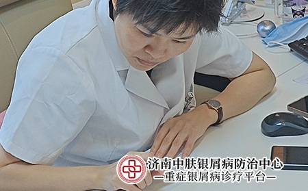 济南赵雪欢脓疱型银屑病 - 济南中肤银屑病中心