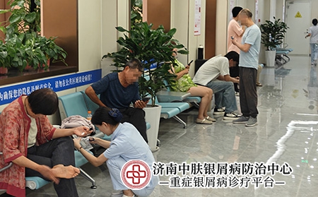 济南脓疱型银屑病治疗-济南中肤医院