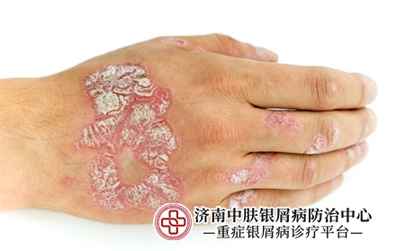 斑块状银屑病1