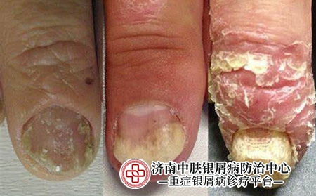指甲牛皮癣2